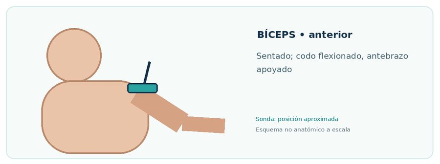 Esquema didáctico de colocación de sonda para Bíceps